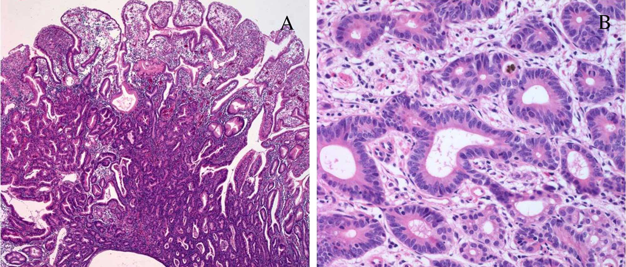 gastric-adenocarcinoma