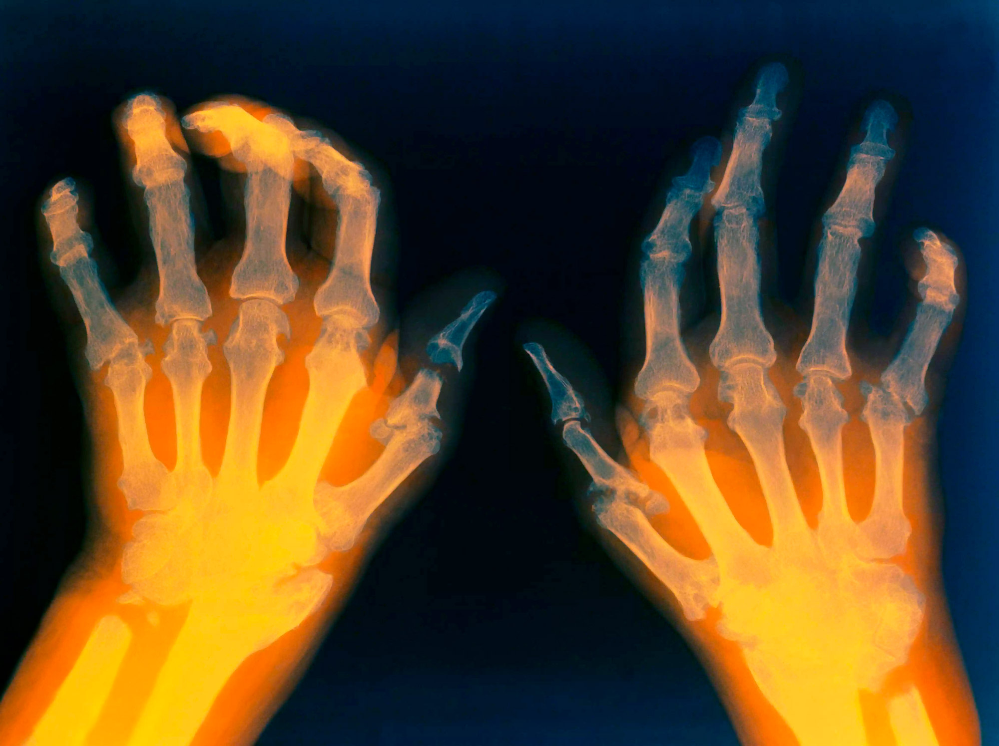 Ревматоидный артрит на руках фото